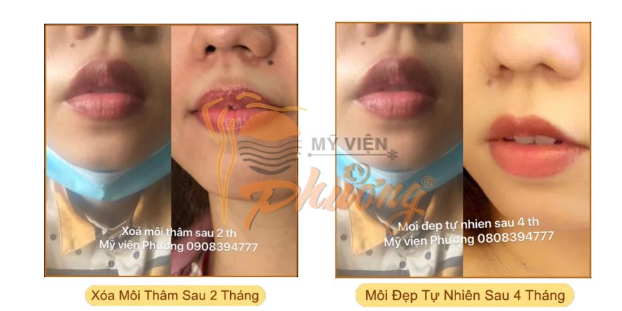 Kết quả sau Phun môi Collagen