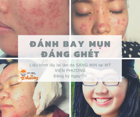 TRỊ MỤN UY TÍN TẠI MỸ VIỆN PHƯƠNG