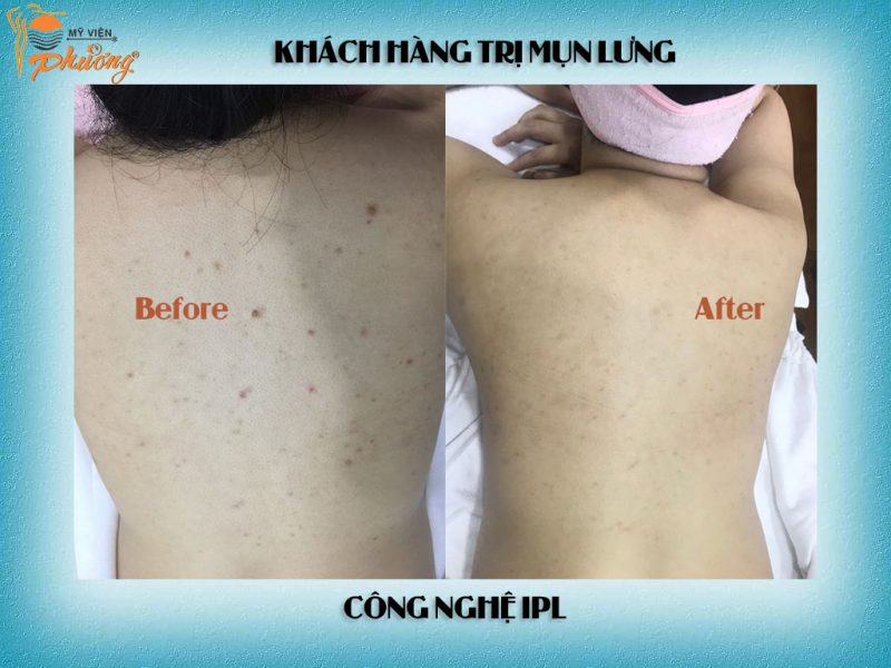 Khách hàng trị mụn lưng hiệu quả tại Mỹ viện Phương