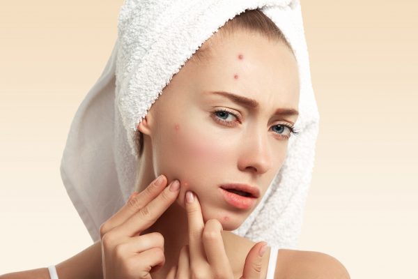 Điều trị mụn ở tuổi dậy thì