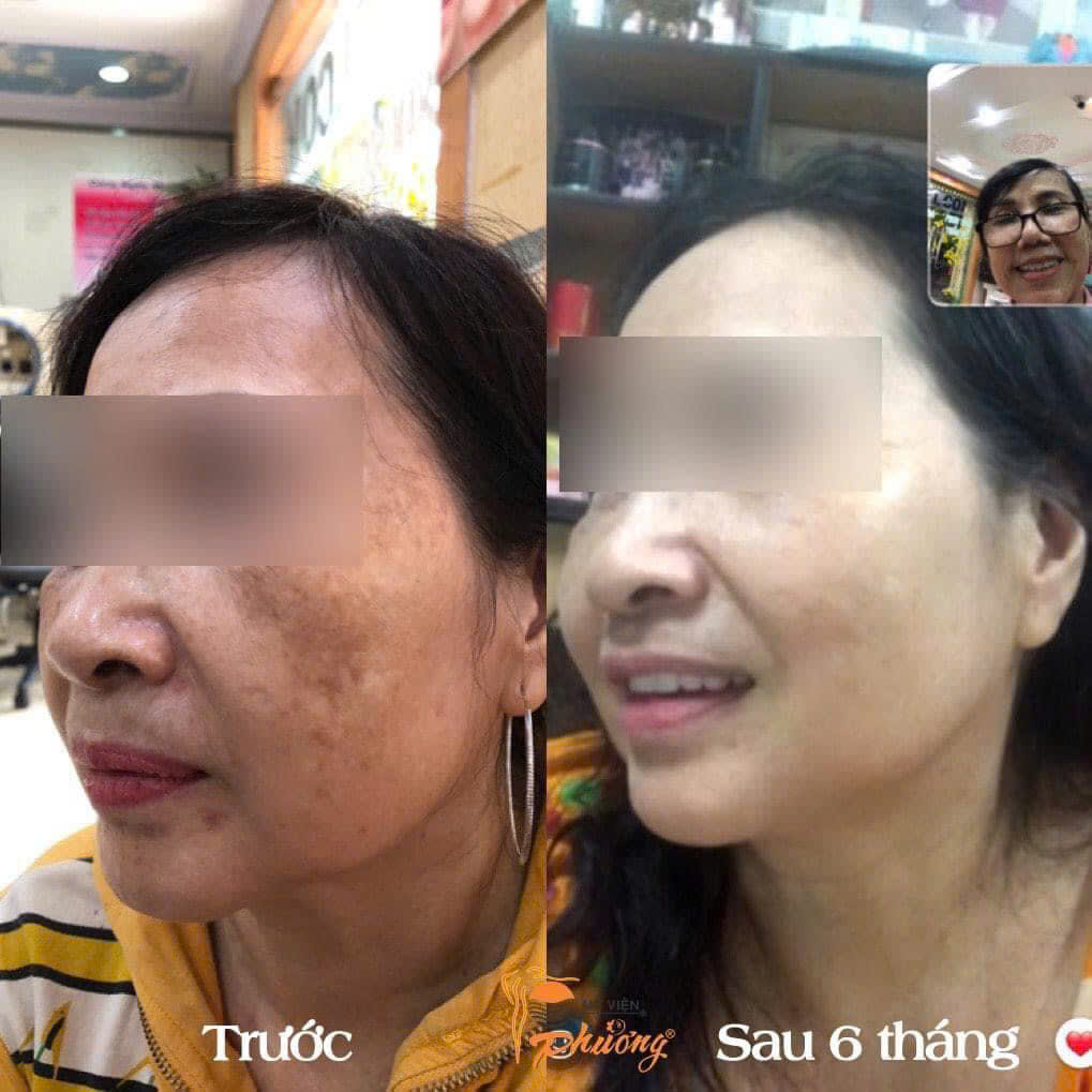 Khách hàng sử dụng liệu trình trị nám tại Mỹ Viện Phương