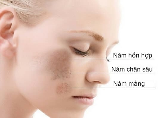 Điều Trị Nám Bằng Laser Có Hết Hẳn Không? Ưu Nhược Điểm Cần Biết Điều Trị Nám Bằng Laser Có Hết Hẳn Không? Ưu Nhược Điểm Cần Biết