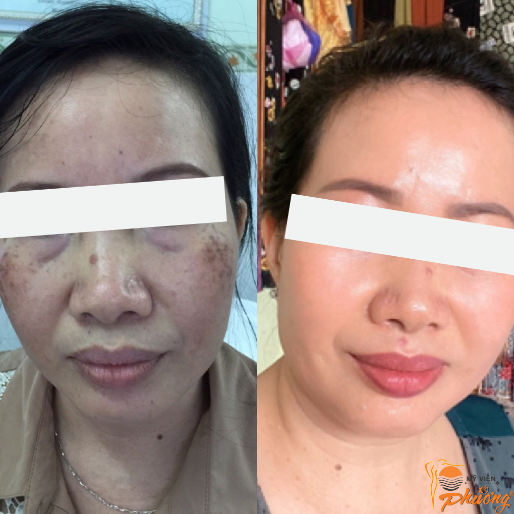Cảm Nhận Của Khách Hàng Khi Đến Trị Nám Tại Mỹ Viện Phương