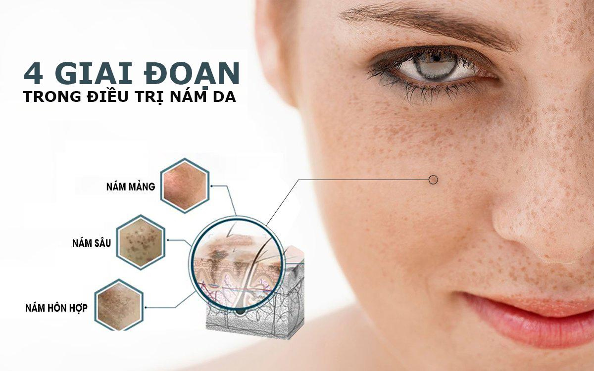 Liệu trình trị nám bao lâu thì hết?