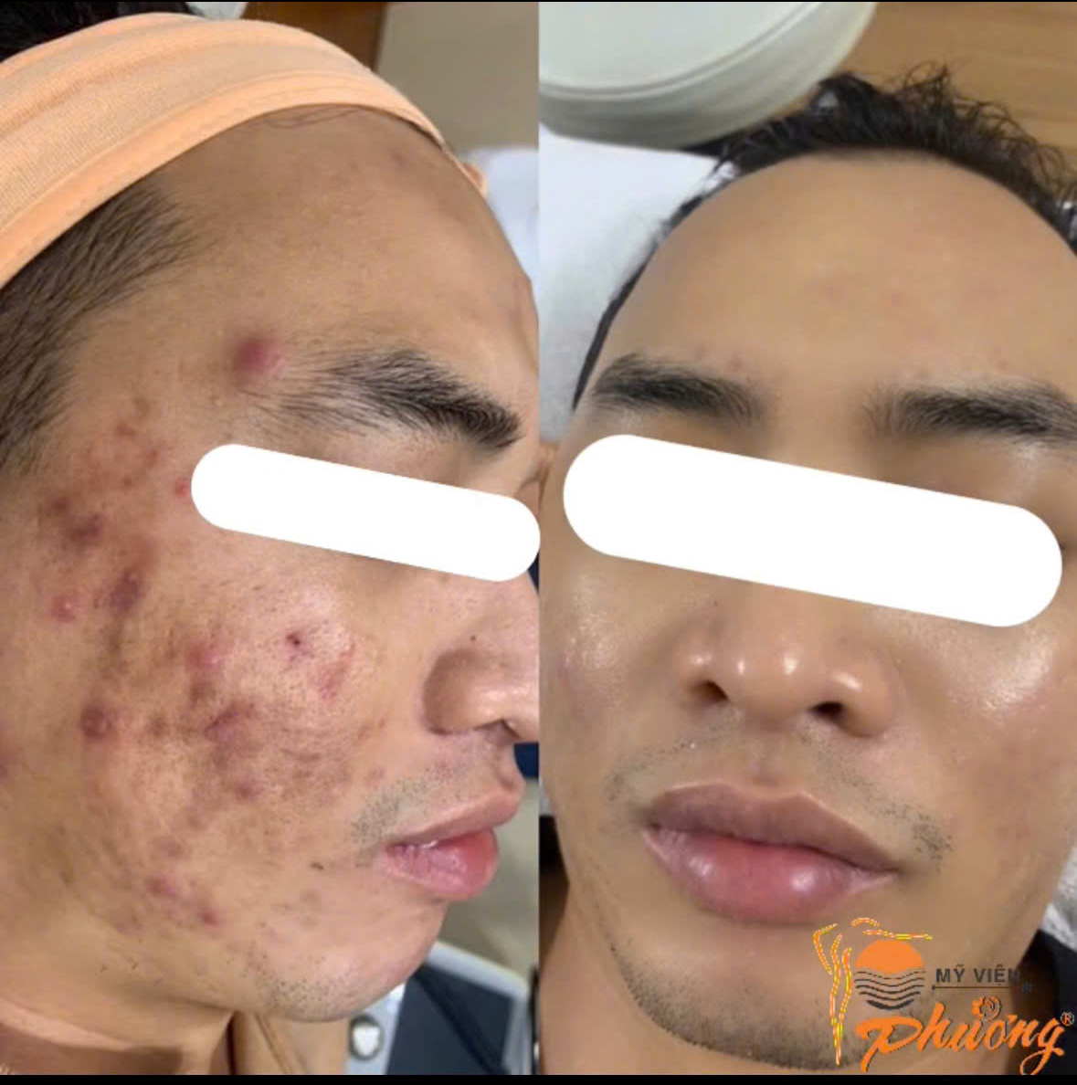 Khách hàng điều trị mụn tại MVP