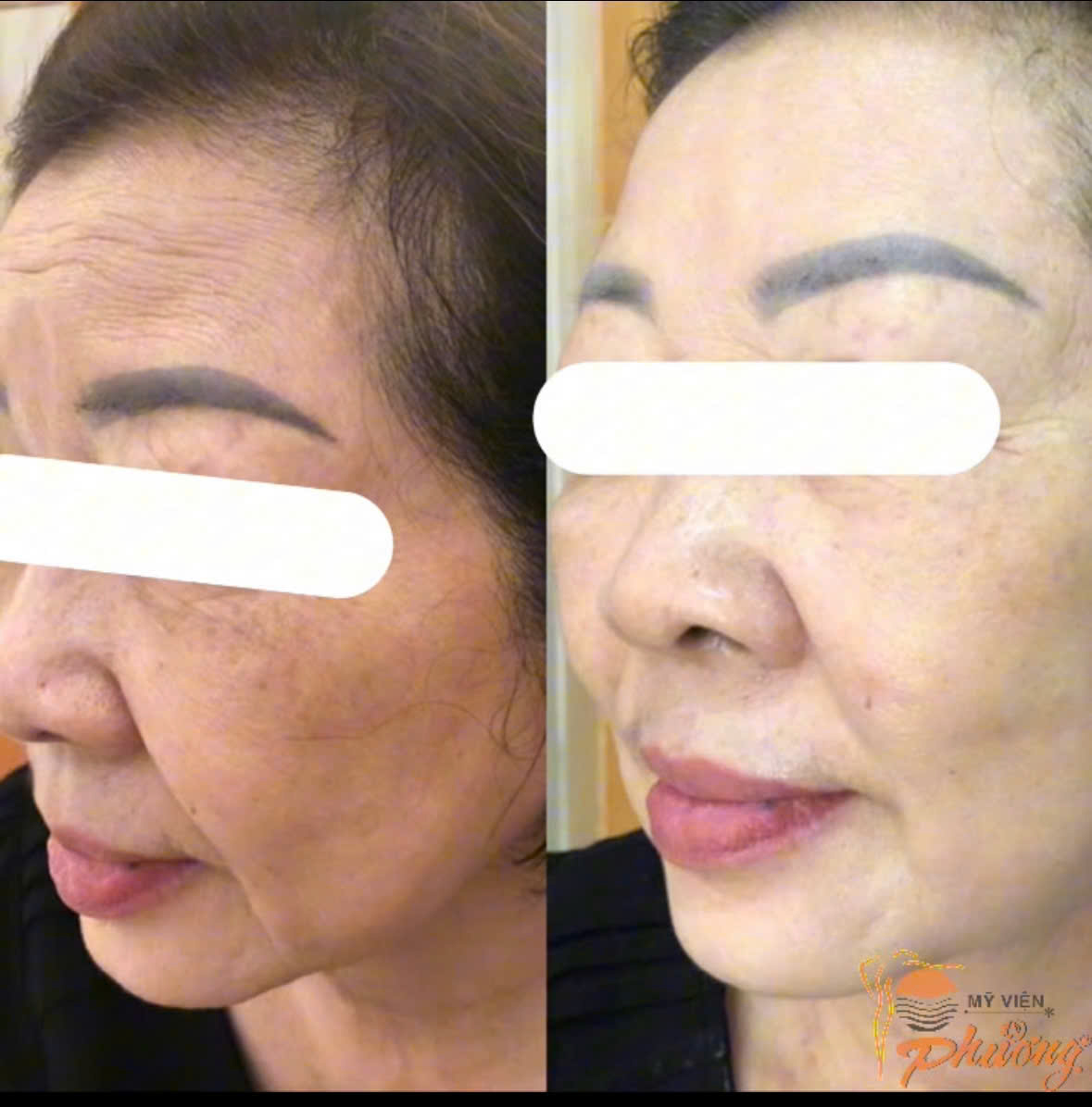 Nâng cơ mặt bằng công nghệ hifu chị em hoàn toàn có thể yên tâm trẻ hóa sắc đẹp ở da.