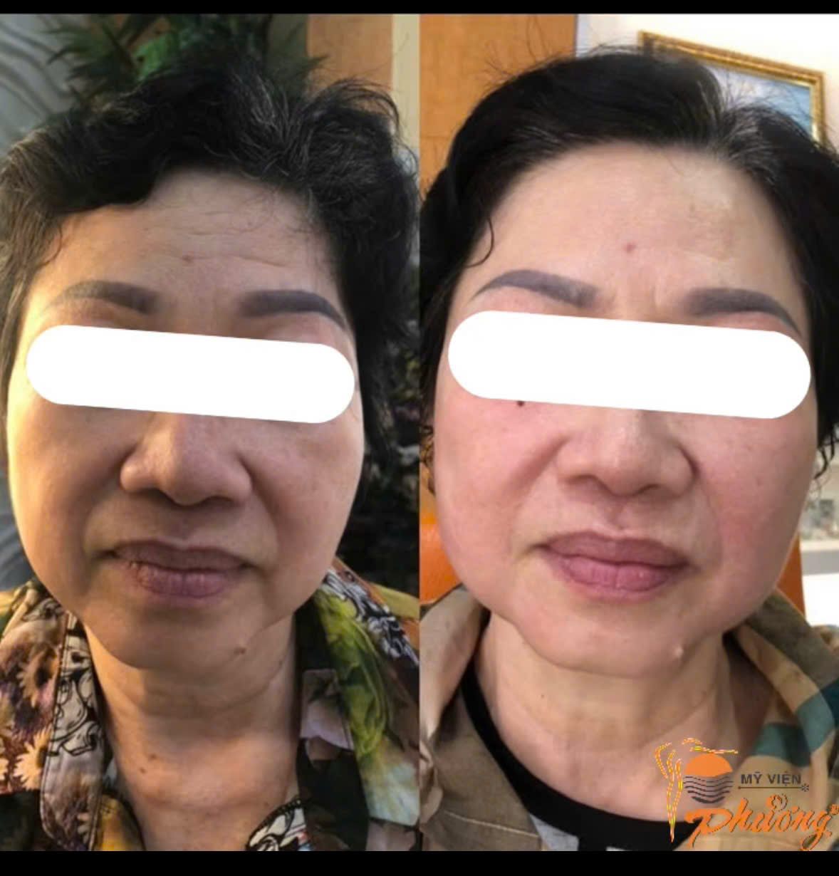 khách hàng sử dụng liệu tình trẻ hóa bằng công nghệ Hifu tại Mỹ Viện Phương
